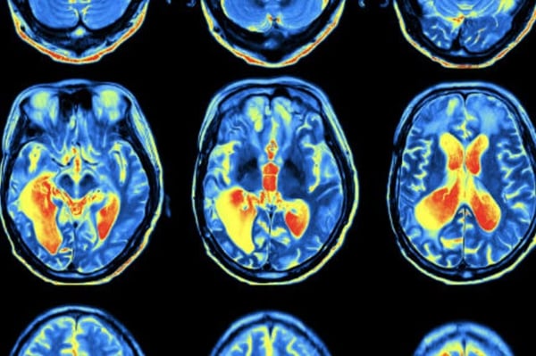 Neurensics fmri scan onze aanpak